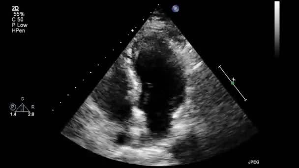 Hochwertige Video Ultraschall Transesophagealuntersuchung Des Herzens — Stockvideo