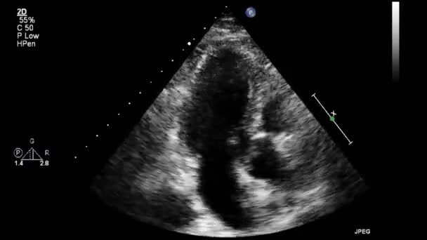 Hochwertige Video Ultraschall Transesophagealuntersuchung Des Herzens — Stockvideo