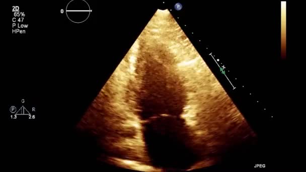 Vysoce Kvalitní Video Ultrazvukové Transesofageální Vyšetření Srdce — Stock video