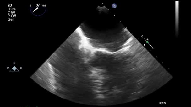 Examen Transesofágico Por Ultrasonido Video Alta Calidad Del Corazón — Vídeos de Stock