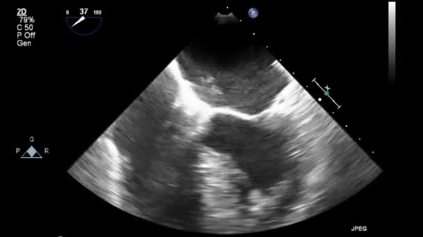 Examen Transesofágico Por Ultrasonido Video Alta Calidad Del Corazón — Vídeos de Stock