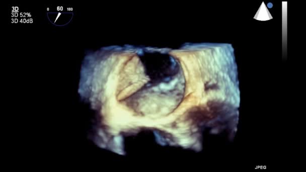 Hög Kvalitet Video Ultraljud Transesofageal Undersökning Hjärtat — Stockvideo