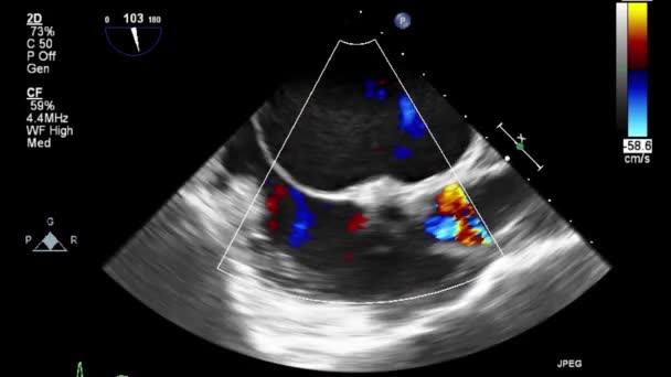 Hoge Kwaliteit Video Echografie Transslokdarmonderzoek Van Het Hart — Stockvideo