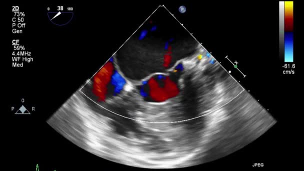 Hoge Kwaliteit Video Echografie Transslokdarmonderzoek Van Het Hart — Stockvideo