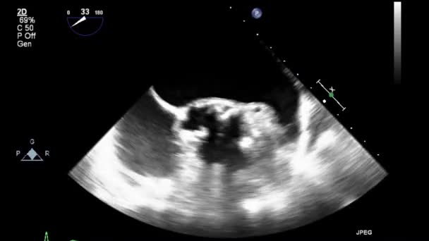 Vídeo Ultra Som Alta Qualidade Exame Transesofágico Coração — Vídeo de Stock