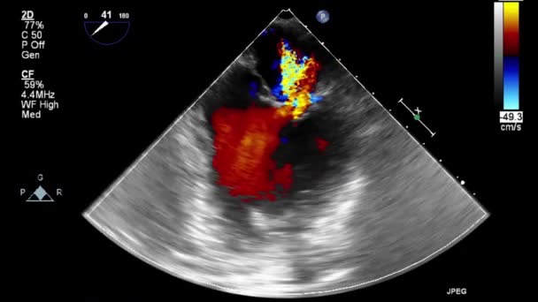 Examen Transesofágico Por Ultrasonido Video Alta Calidad Del Corazón — Vídeo de stock