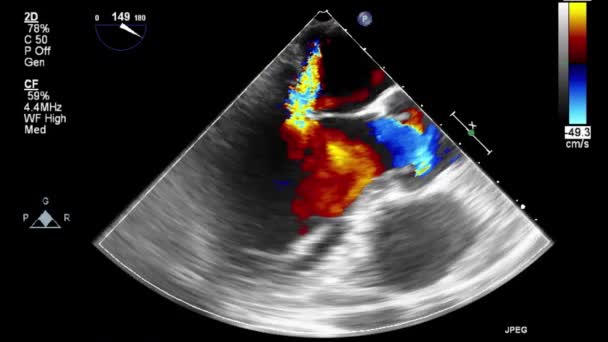 Hoge Kwaliteit Video Echografie Transslokdarmonderzoek Van Het Hart — Stockvideo