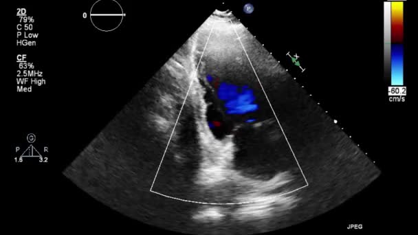 Examen Transesofágico Por Ultrasonido Video Alta Calidad Del Corazón — Vídeo de stock