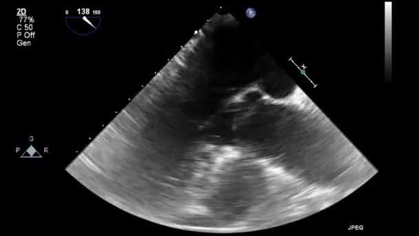 Échographie Vidéo Haute Qualité Examen Transœsophagien Cœur — Video