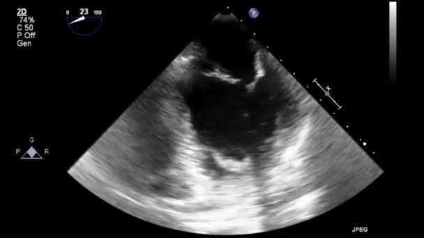 Hochwertige Video Ultraschall Transesophagealuntersuchung Des Herzens — Stockvideo