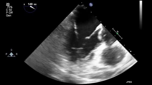 Hochwertige Video Ultraschall Transesophagealuntersuchung Des Herzens — Stockvideo