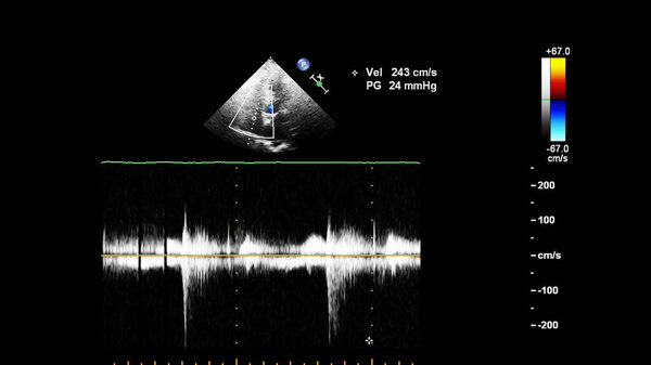 Экран эхокардиографической (ультразвуковой) машины
.