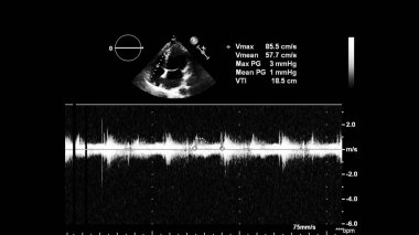Kalp görüntüsü ne reisi olan bir ultrason makinesinin ekranı.
