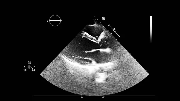 Экран ультразвукового аппарата с изображением сердца . — стоковое фото