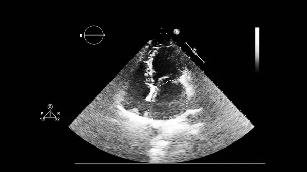 Schermo di una macchina ad ultrasuoni con un'immagine del cuore . — Foto Stock