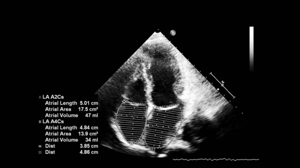 Écran d'une machine à ultrasons avec une image cardiaque . — Photo