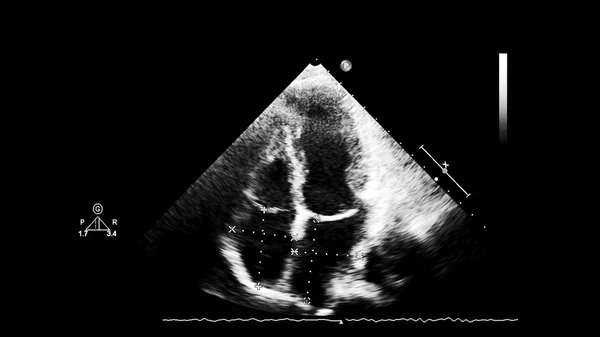 Bildschirm eines Ultraschallgeräts mit einem Herzbild. — Stockfoto