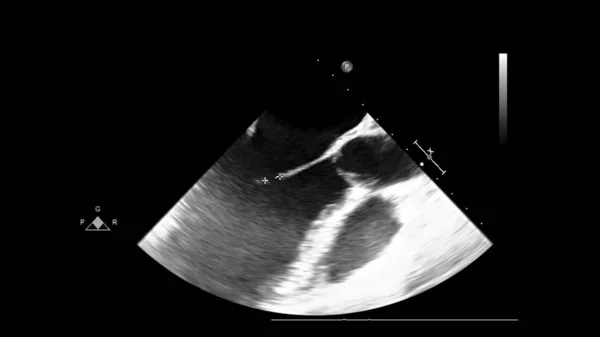 Schermo di una macchina ad ultrasuoni con un'immagine del cuore . — Foto Stock