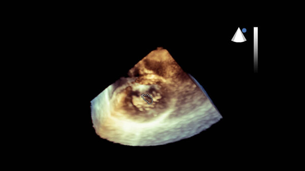 Экран ультразвукового аппарата с изображением сердца
.