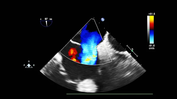 Экран ультразвукового аппарата с изображением сердца . — стоковое фото