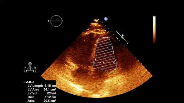 Bildschirm eines Ultraschallgeräts mit einem Herzbild. — Stockfoto