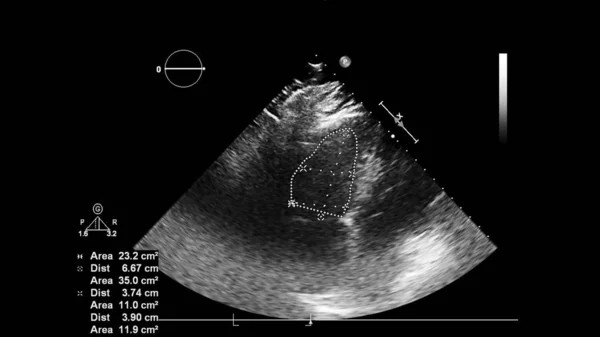 Ekran ultradźwiękowej maszyny z obrazem serca. — Zdjęcie stockowe