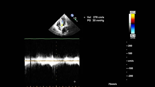 Tela de uma máquina de ultrassom com uma imagem de coração . — Fotografia de Stock