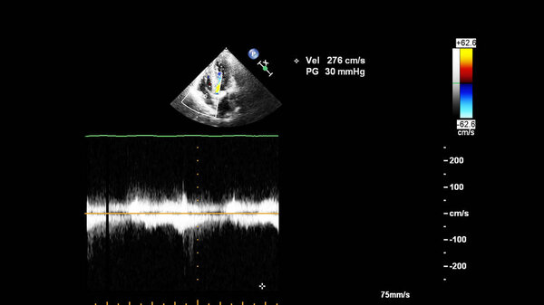 Screen of an ultrasound machine with a heart image.