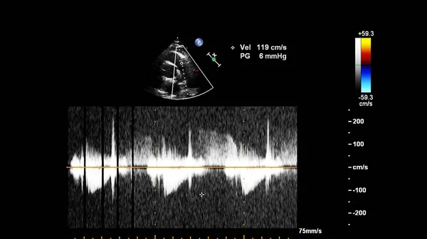 Екран ультразвукової машини з зображенням серця . — стокове фото