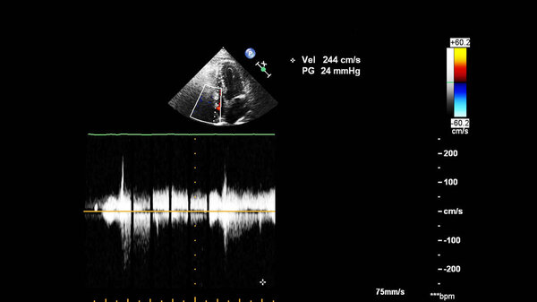 Screen of an ultrasound machine with a heart image.