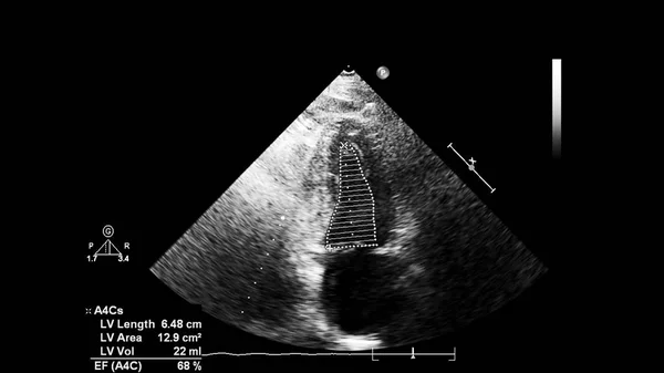 Écran d'une machine à ultrasons avec une image cardiaque . — Photo