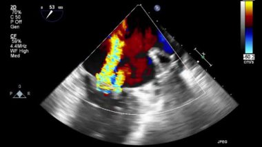 Kalbin yüksek kaliteli ultrason transsofageal muayenesi..