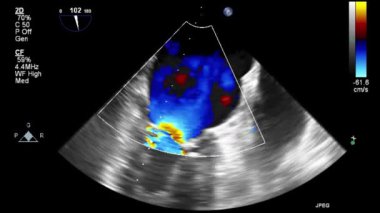 Kalbin yüksek kaliteli ultrason transsofageal muayenesi..