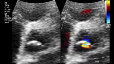 Kalbin yüksek kaliteli ultrason transsofageal muayenesi..