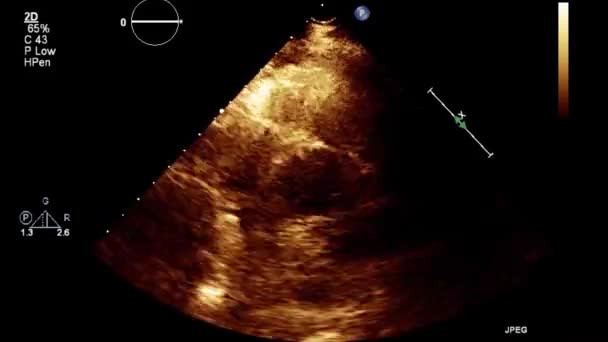 Examen Transesofágico Por Ultrasonido Video Alta Calidad Del Corazón — Vídeos de Stock