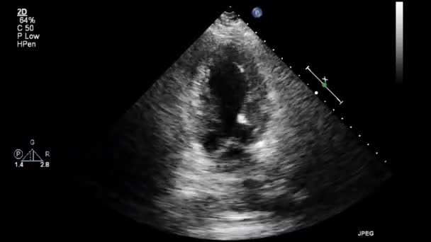 Vídeo Ultra Som Alta Qualidade Exame Transesofágico Coração — Vídeo de Stock