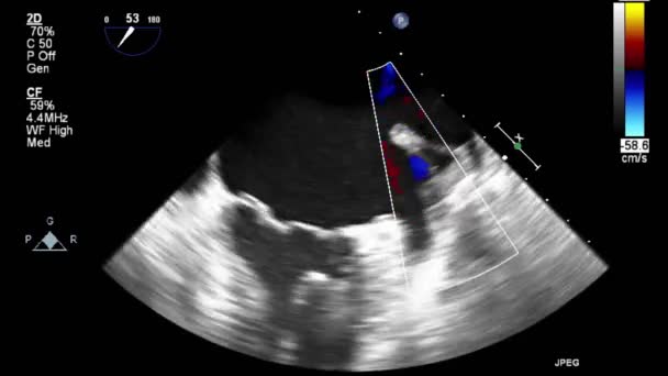 心臓の高品質ビデオ超音波経食道検査 — ストック動画
