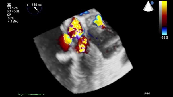 Ecografia Video Alta Qualità Esame Transesofageo Del Cuore — Video Stock