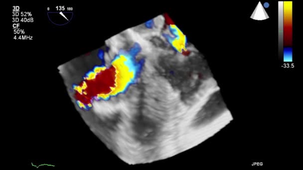 Examen Transesofágico Por Ultrasonido Video Alta Calidad Del Corazón — Vídeo de stock