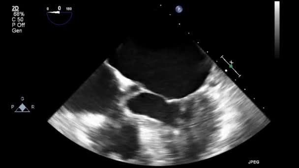 Качественное Видео Ультразвуковое Трансофагеальное Обследование Сердца — стоковое видео
