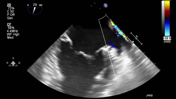 Hoge Kwaliteit Video Echografie Transslokdarmonderzoek Van Het Hart — Stockvideo