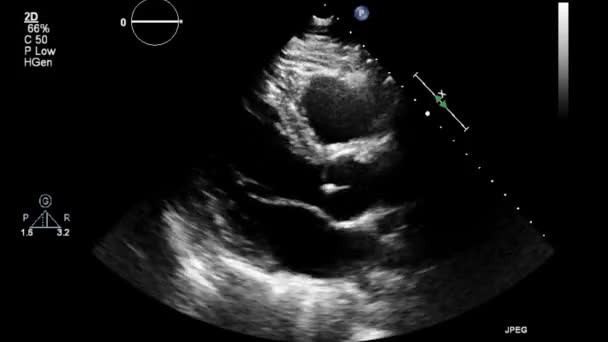 Hoge Kwaliteit Video Echografie Transslokdarmonderzoek Van Het Hart — Stockvideo