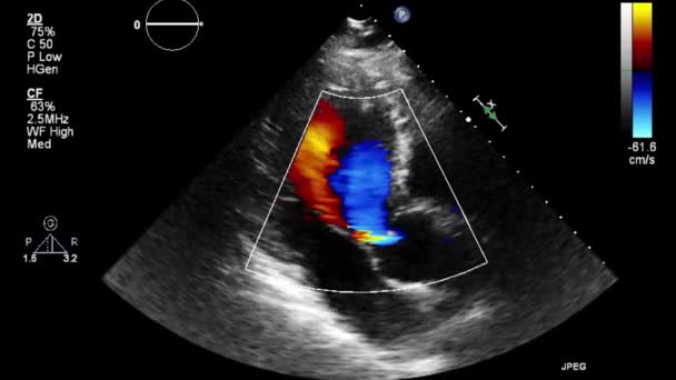 Examen Transesofágico Por Ultrasonido Video Alta Calidad Del Corazón — Vídeos de Stock