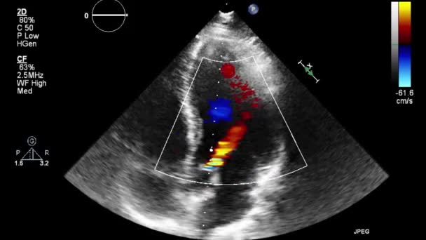 Examen Transesofágico Por Ultrasonido Video Alta Calidad Del Corazón — Vídeo de stock