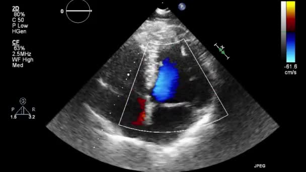 Examen Transesofágico Por Ultrasonido Video Alta Calidad Del Corazón — Vídeos de Stock