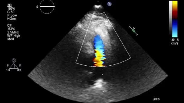 Vysoce Kvalitní Video Ultrazvukové Transesofageální Vyšetření Srdce — Stock video
