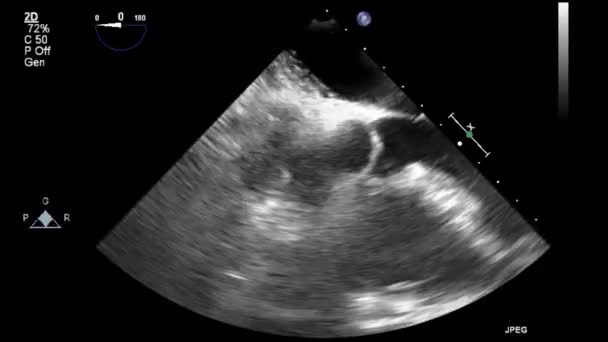 High Quality Video Ultrasound Transesophageal Examination Heart — Stock Video