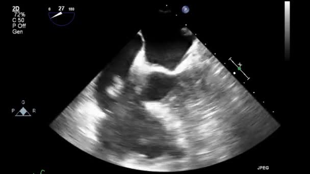 Examen Transesofágico Por Ultrasonido Video Alta Calidad Del Corazón — Vídeo de stock