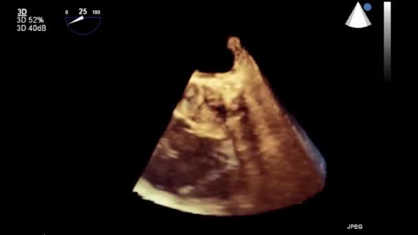 Якісне Відео Ультразвукове Трансофагеальне Дослідження Серця — стокове відео