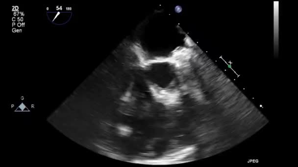 High Quality Video Ultrasound Transesophageal Examination Heart — Stock Video